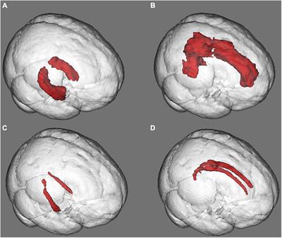 Anosognosia in Amnestic Mild Cognitive Impairment Is Related to Diminished Hippocampal Volume Comparable to Alzheimer’s Disease Dementia: Preliminary MRI Findings